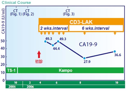 TS-1耐藥后經免疫細胞療法治療后緩解的胃癌案例1