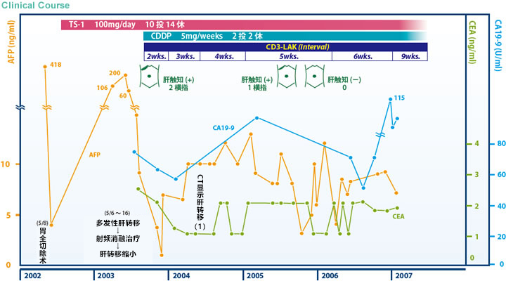 日本免疫細胞治療案例-胃癌